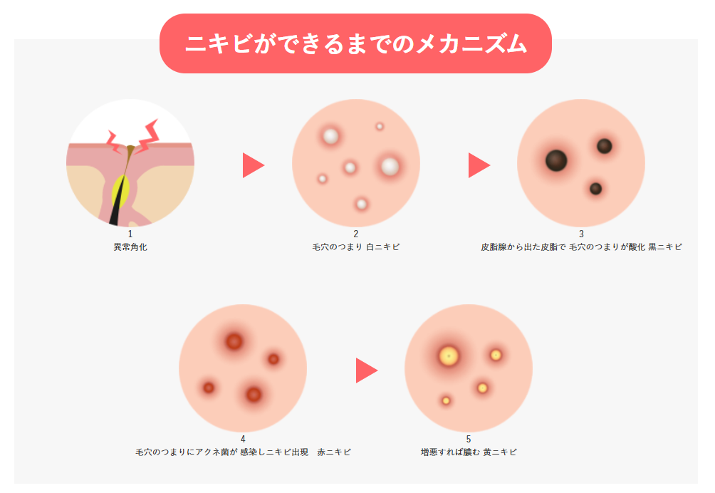 ニキビができるメカニズムを順に説明する図